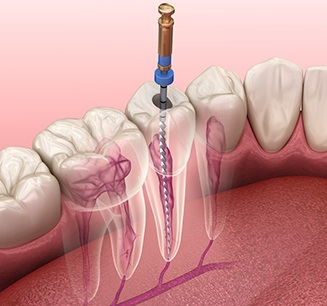 Illustration of root canal treatment for lower arch