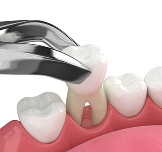 Illustration of tooth being removed with forceps