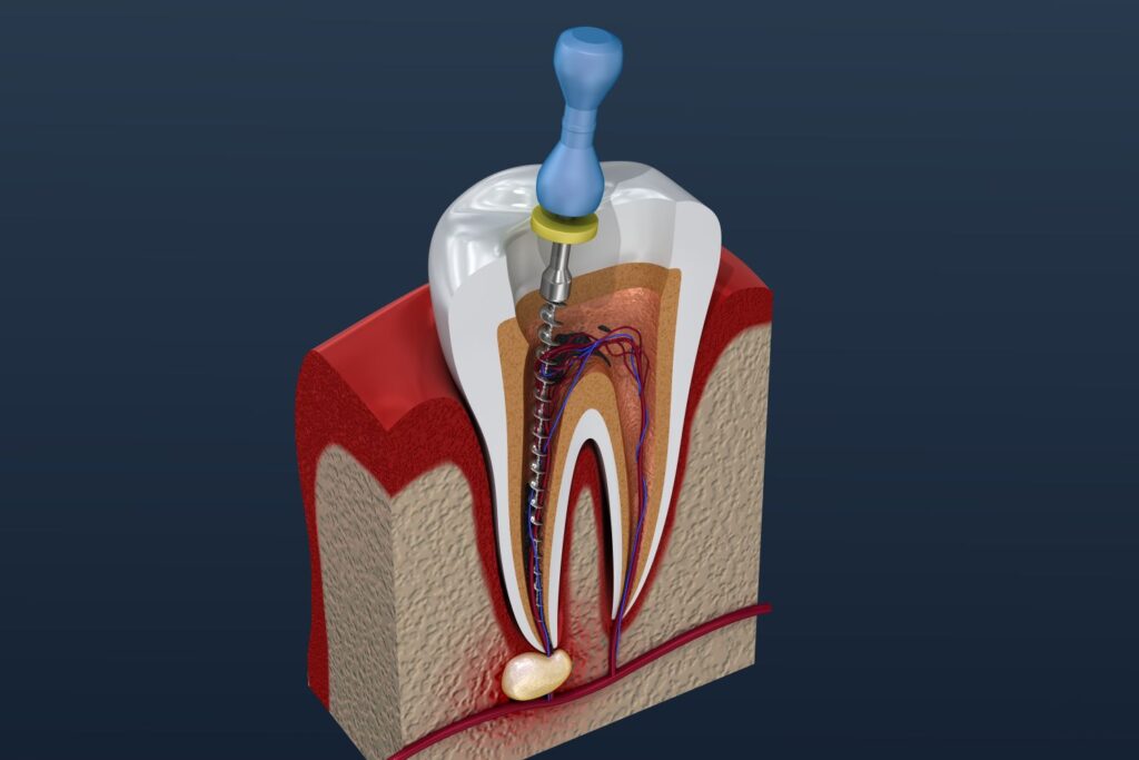 A computer-generated diagram of a tooth undergoing a root canal